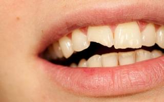 К чему снятся сломанные зубы?